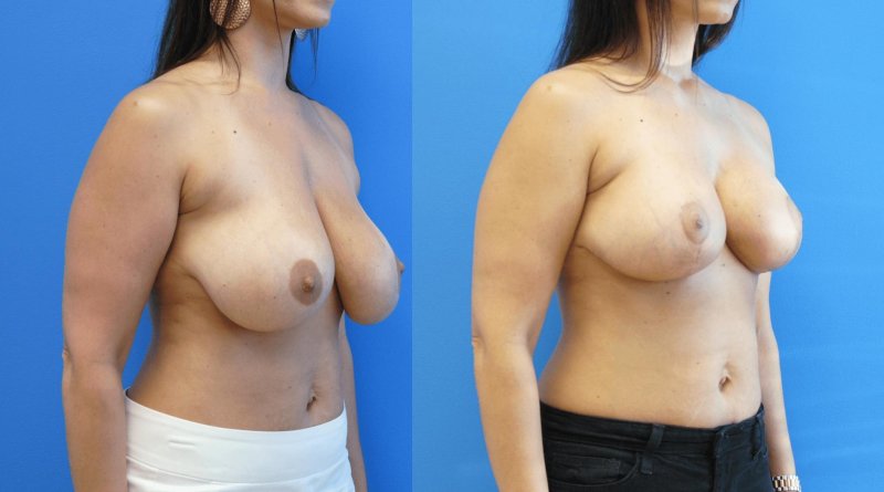 Breast reduction