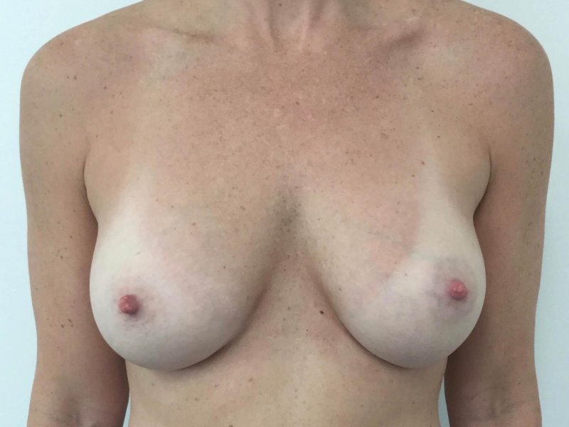 Breast enlargement