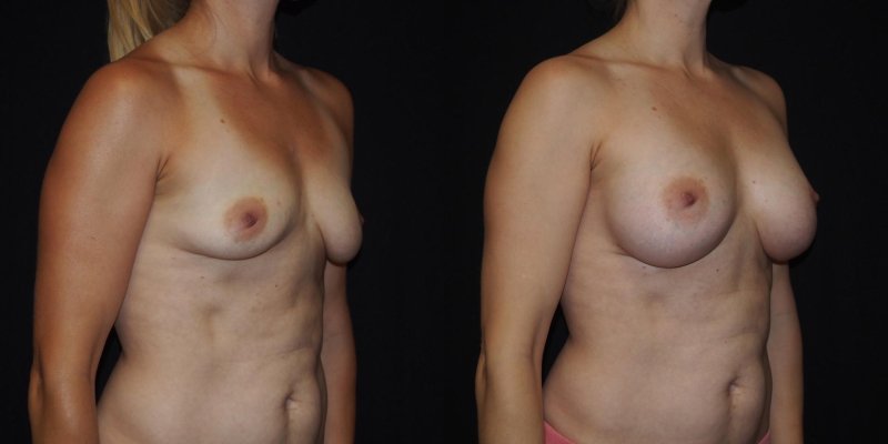 Klainfelter gynecomastia