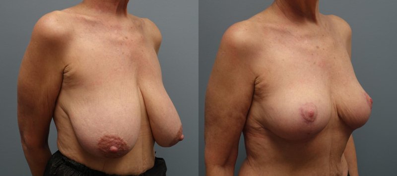 Breast lift