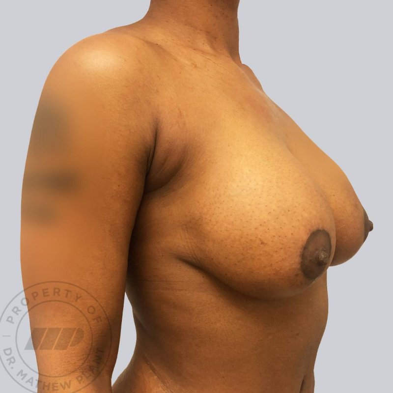 Breast enlargement