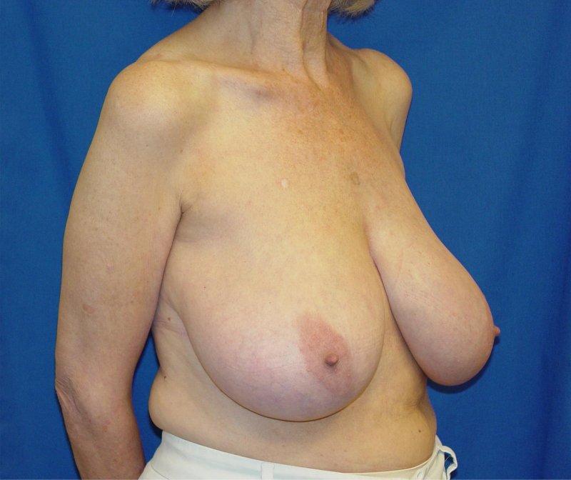 Big sagging chest