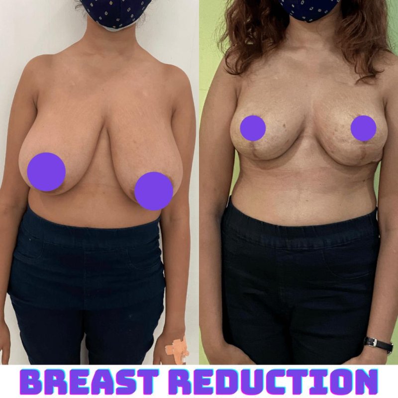 Breast reduction