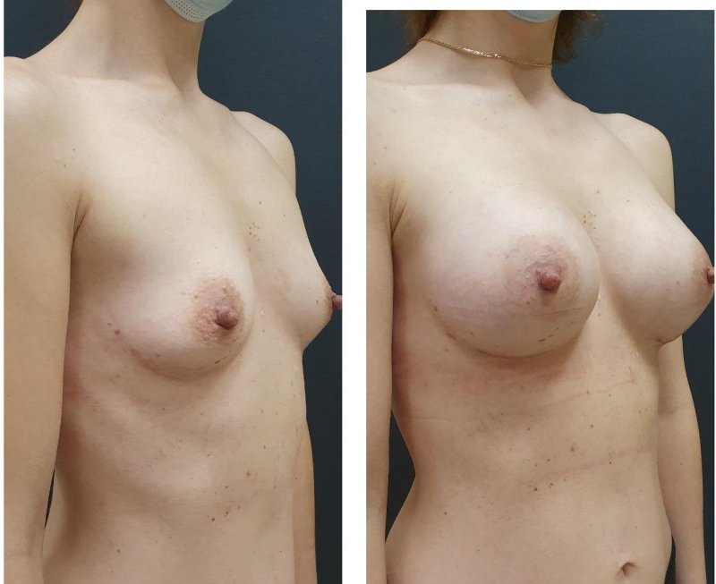 Plastic surgery of breast