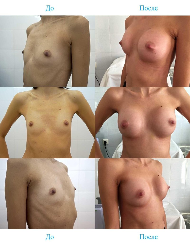 Breasts before and after surgery