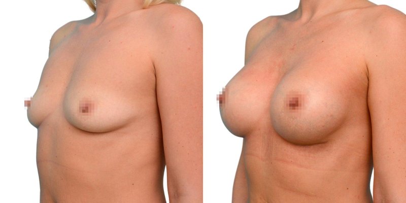 Breast plastic