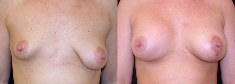 What is tubular breasts