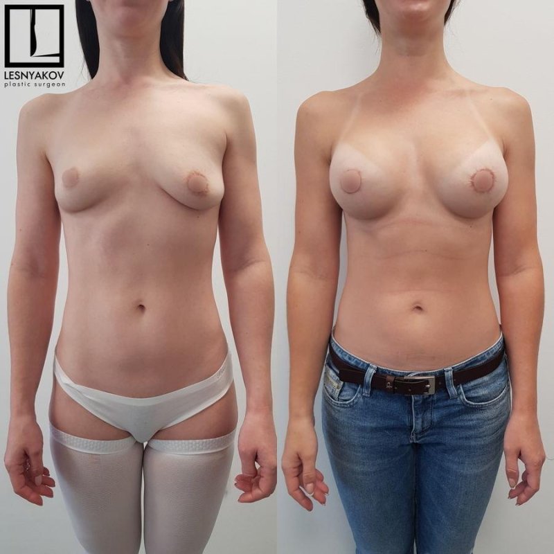Asymmetric breasts