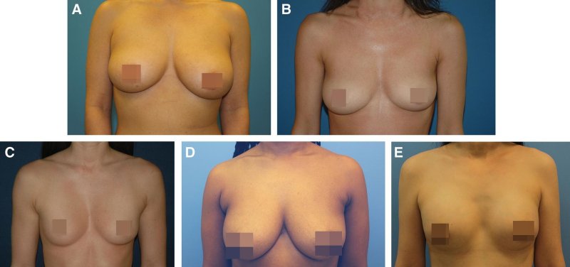 Breast plastic