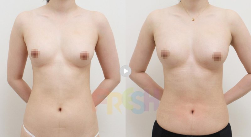 Breast surgery