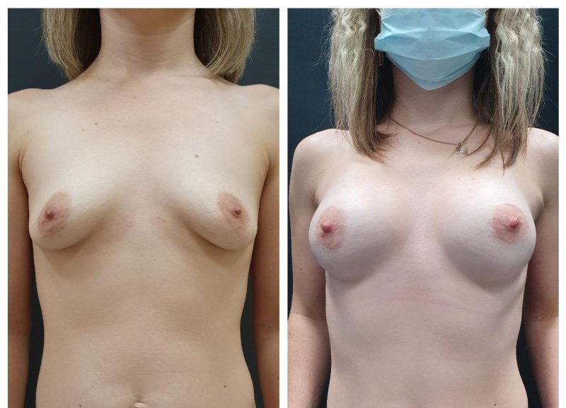 Plastic surgery for chest