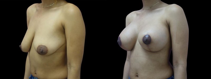 Breast augmentation