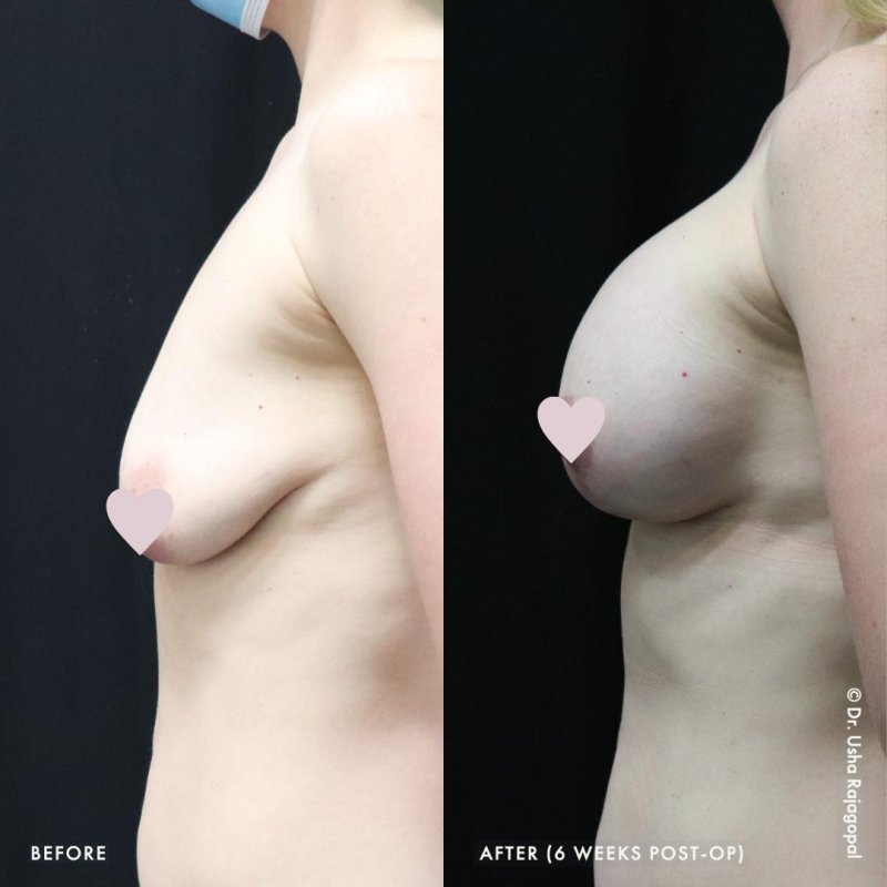 Breast enlargement