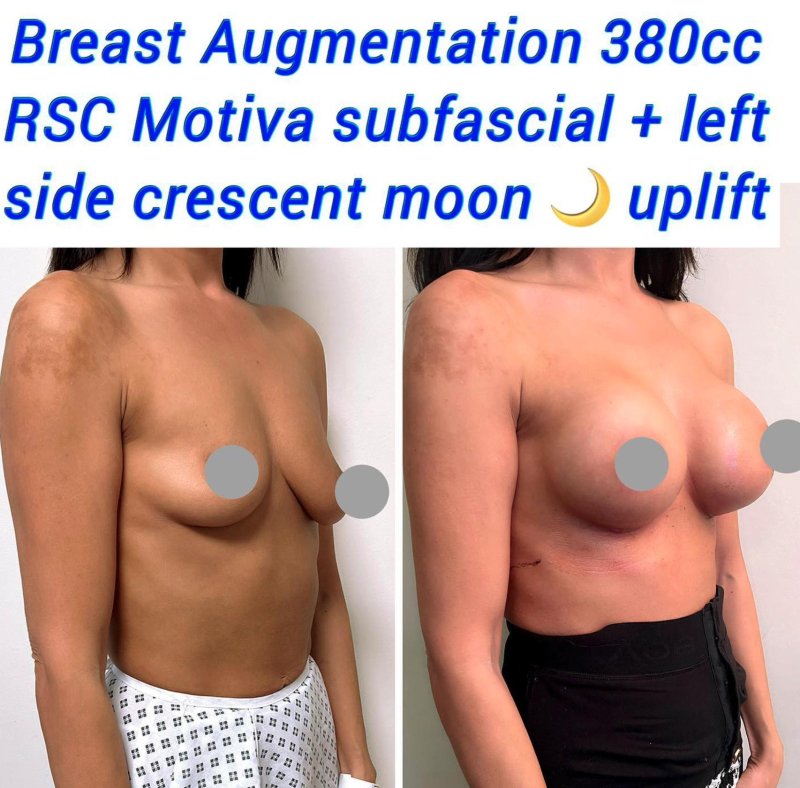 Breast augmentation