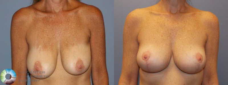 Breast augmentation