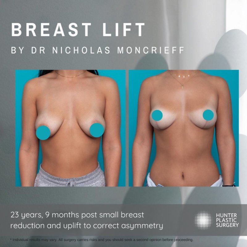 Breast lift
