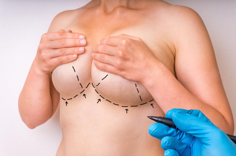 Reduction mammoplasty