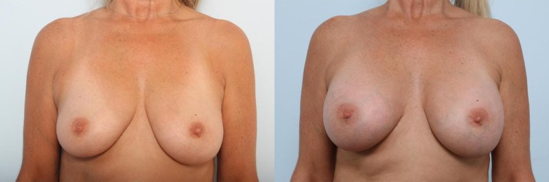 Breast plastic