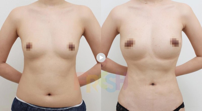Breast plastic