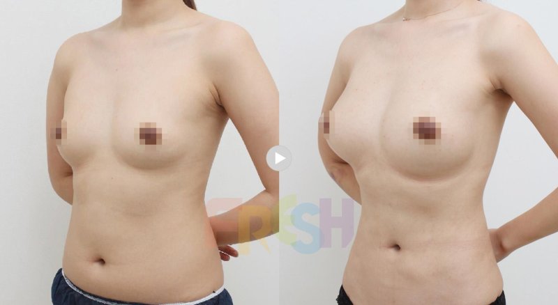 Breast enlargement