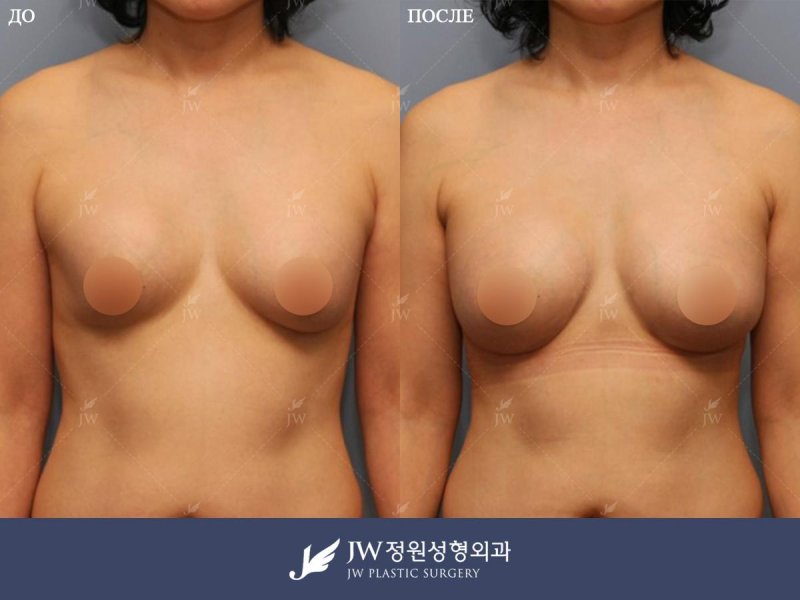 Breast plastic