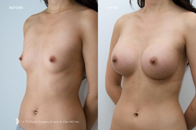 Breast enlargement
