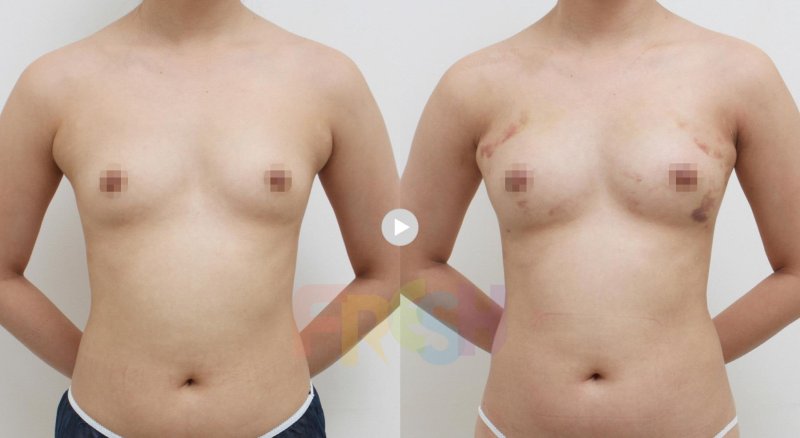Breast plastic surgery