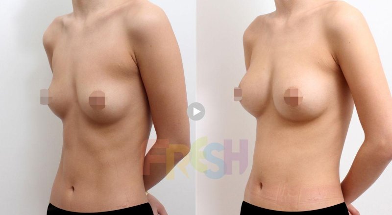 Breast enlargement