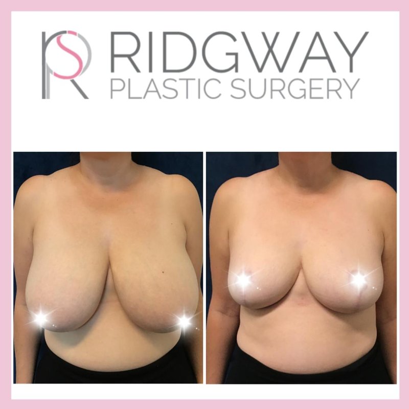 Breast plastic