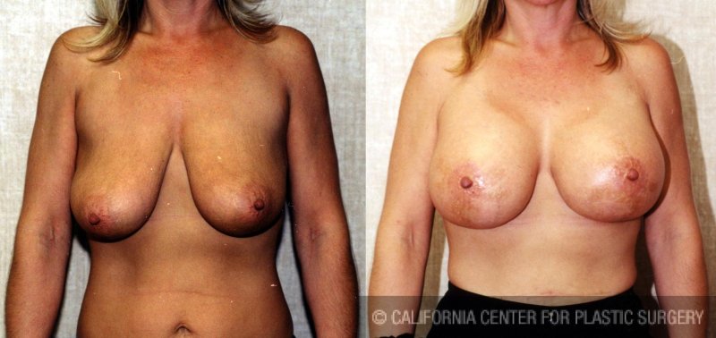 Breast plastic