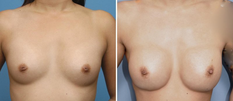 Breast augmentation