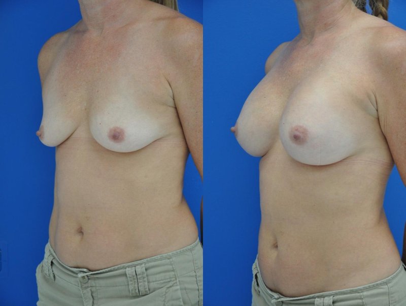Breast plastic