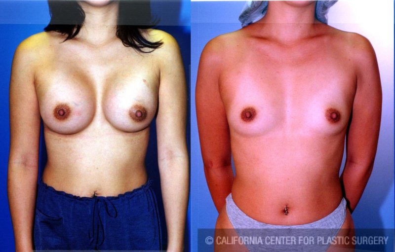 Breast augmentation