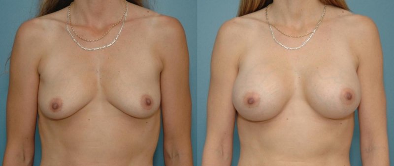 Breast augmentation