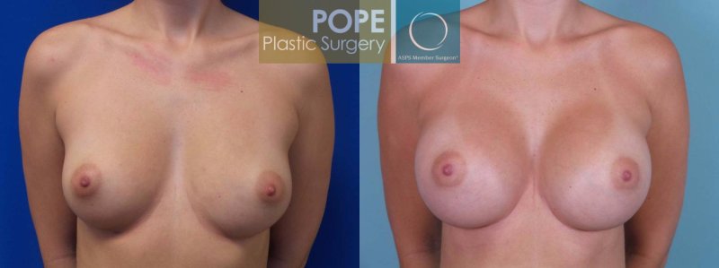 Breast enlargement