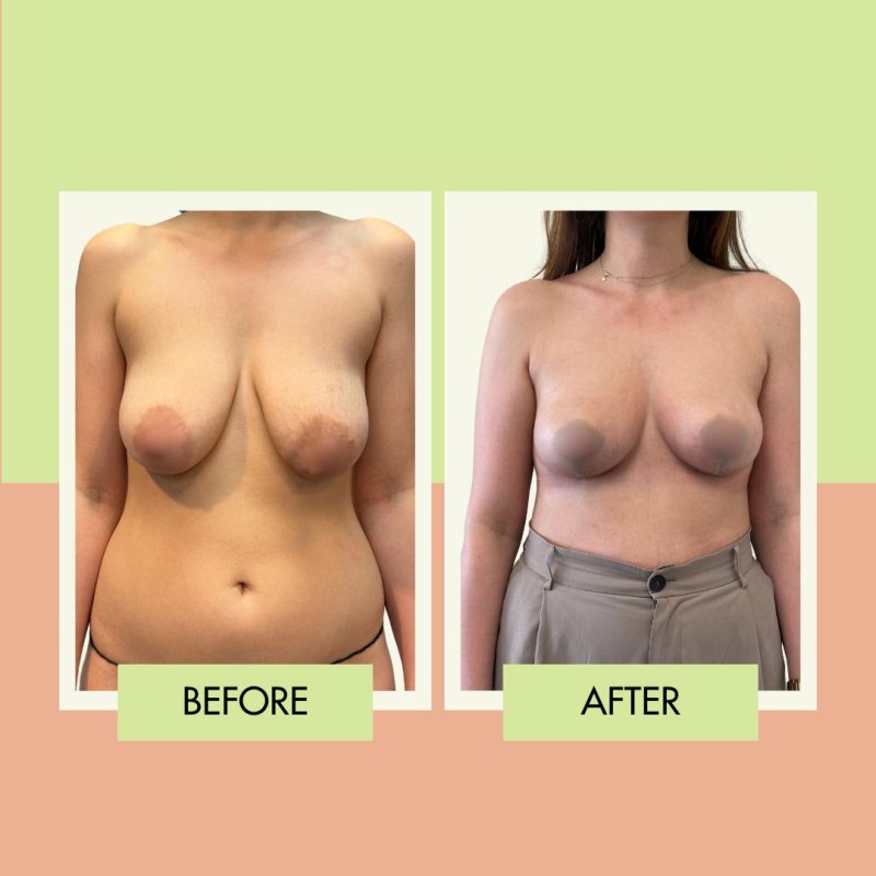 For breast augmentation