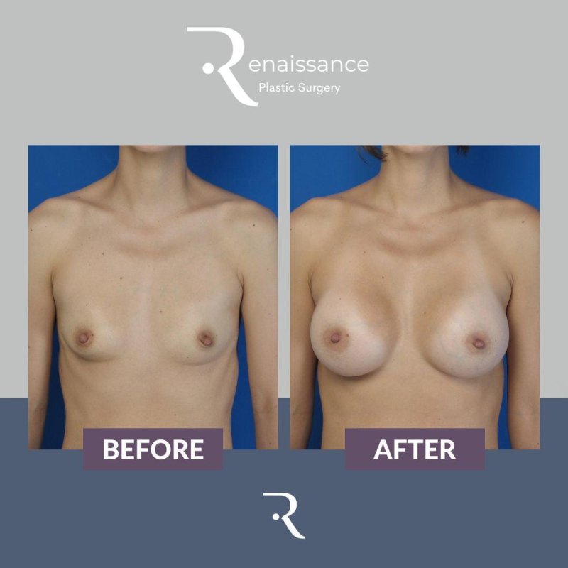 Breast augmentation
