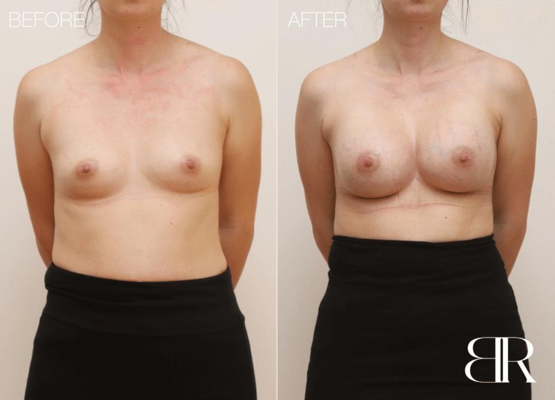 Breast augmentation