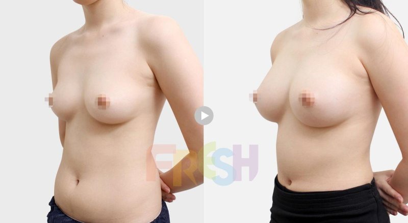 Breast surgery