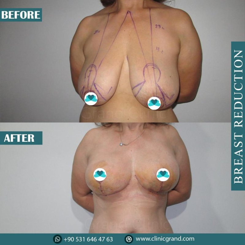 Reduction mammoplasty