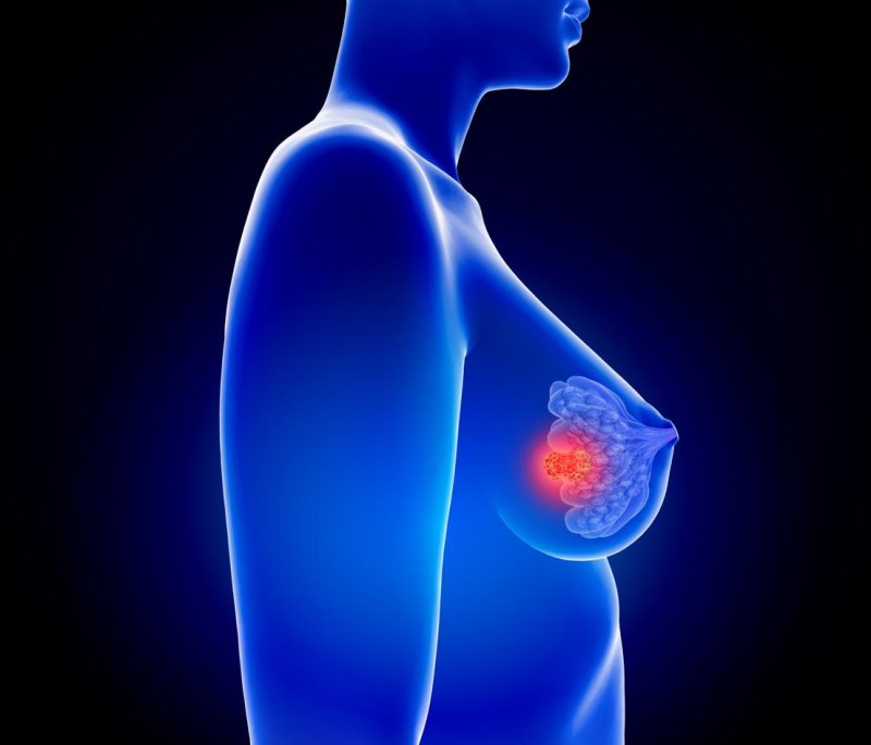 Breast cancer