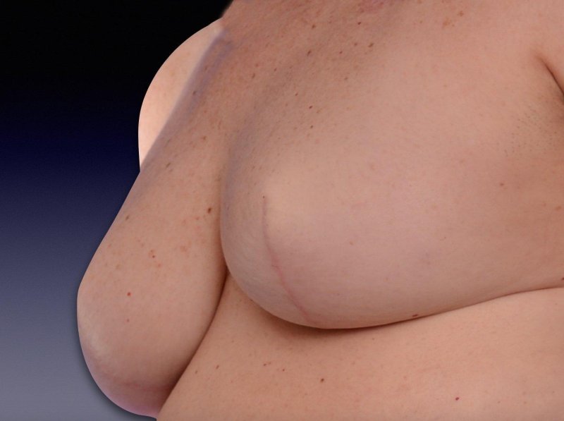 Female breasts