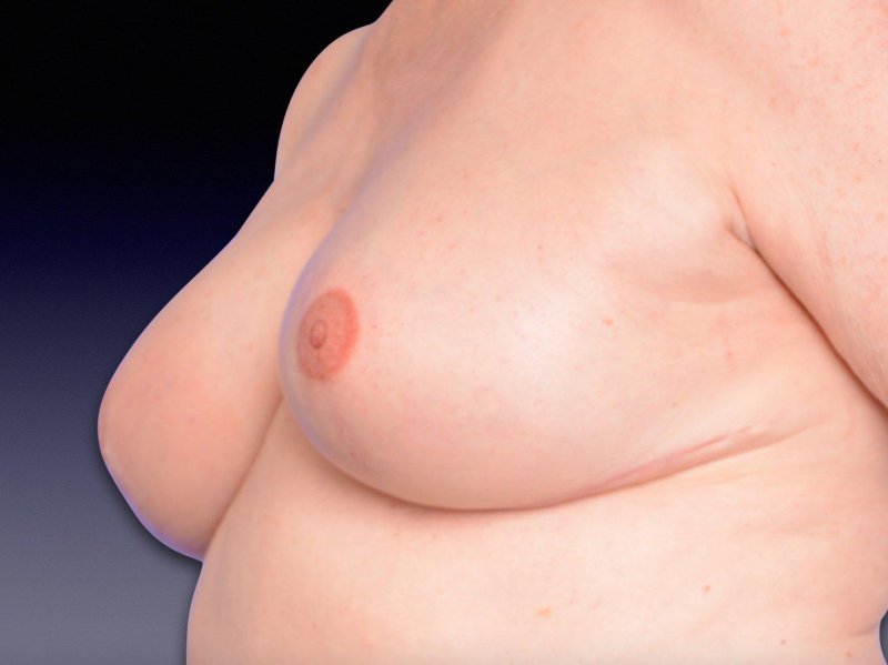 Breast reconstruction