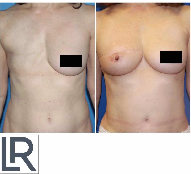 Breast plastic