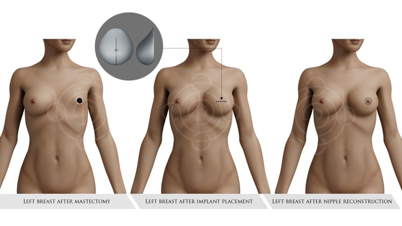 Asymmetry of the female breast