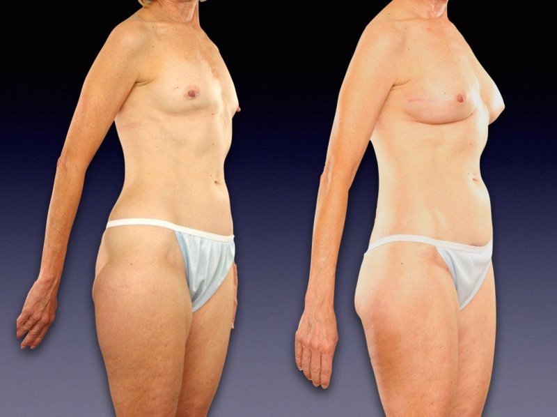 Body liposuction