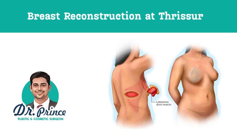 Breast reconstruction