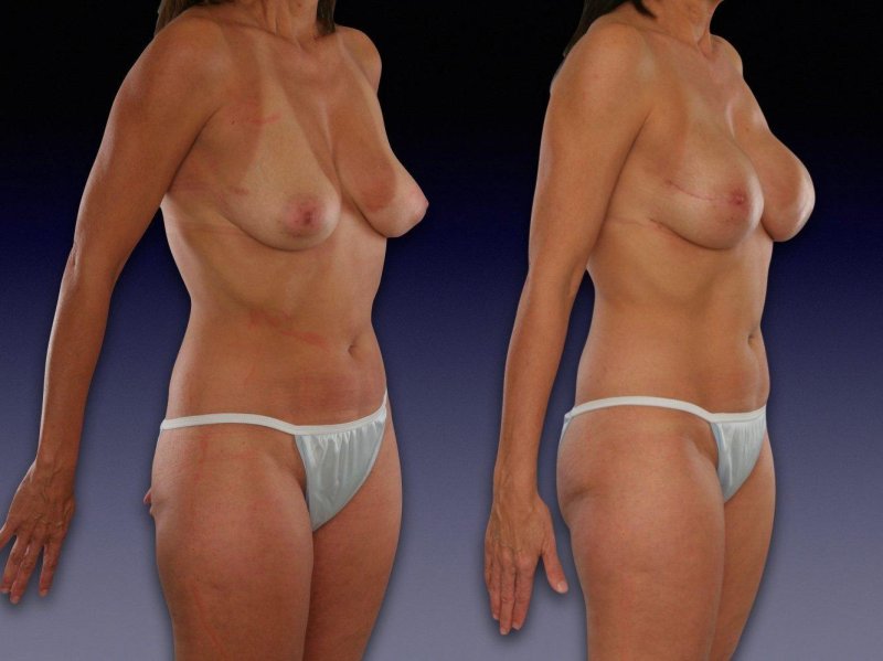 Mastectomy porn actresses