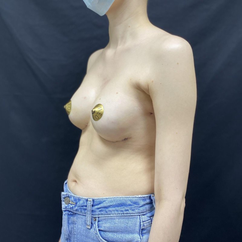 Total Mastectomy