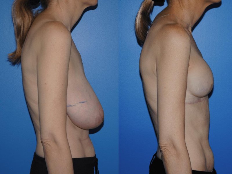 Breast augmentation
